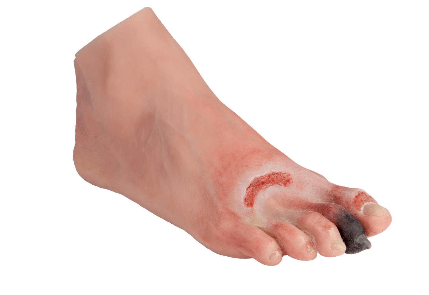 k.A. - Wundenfuß mit diabetischem Fußsyndrom