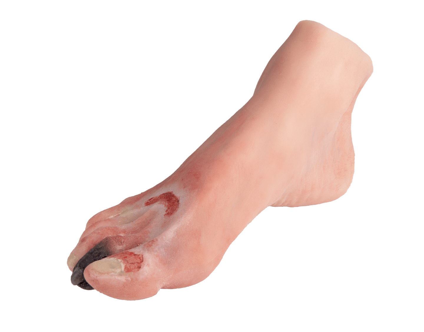k.A. - Wundenfuß mit diabetischem Fußsyndrom